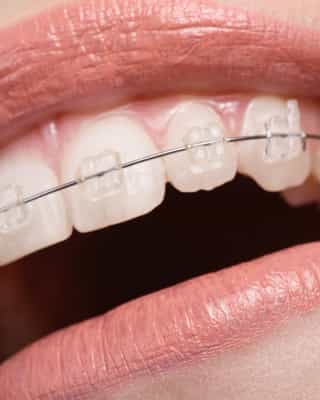 Orthodontic Care